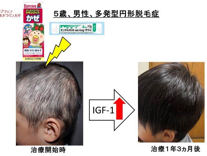円形脱毛症　病院